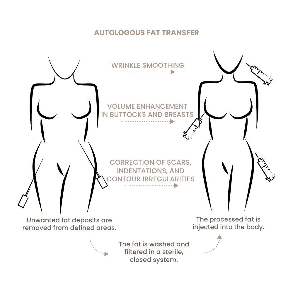 Illustration der Fetttransfers bei Körperkonturierung und Hautstraffung.