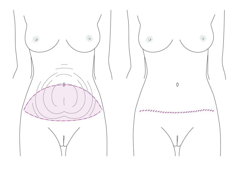 Skin tightening and body contouring illustration for abdominal and waist area.