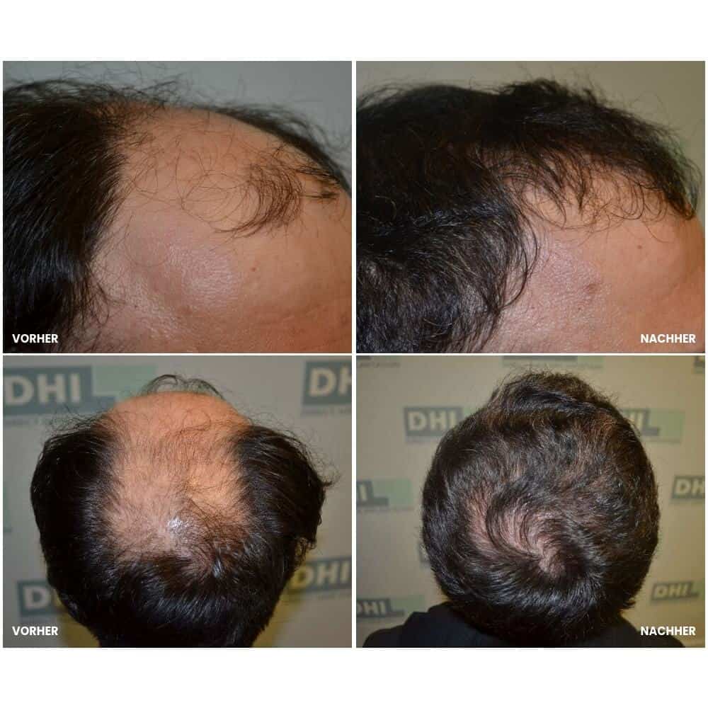 Vorher-Nachher Bilder von Haartransplantation bei Haarausfall.