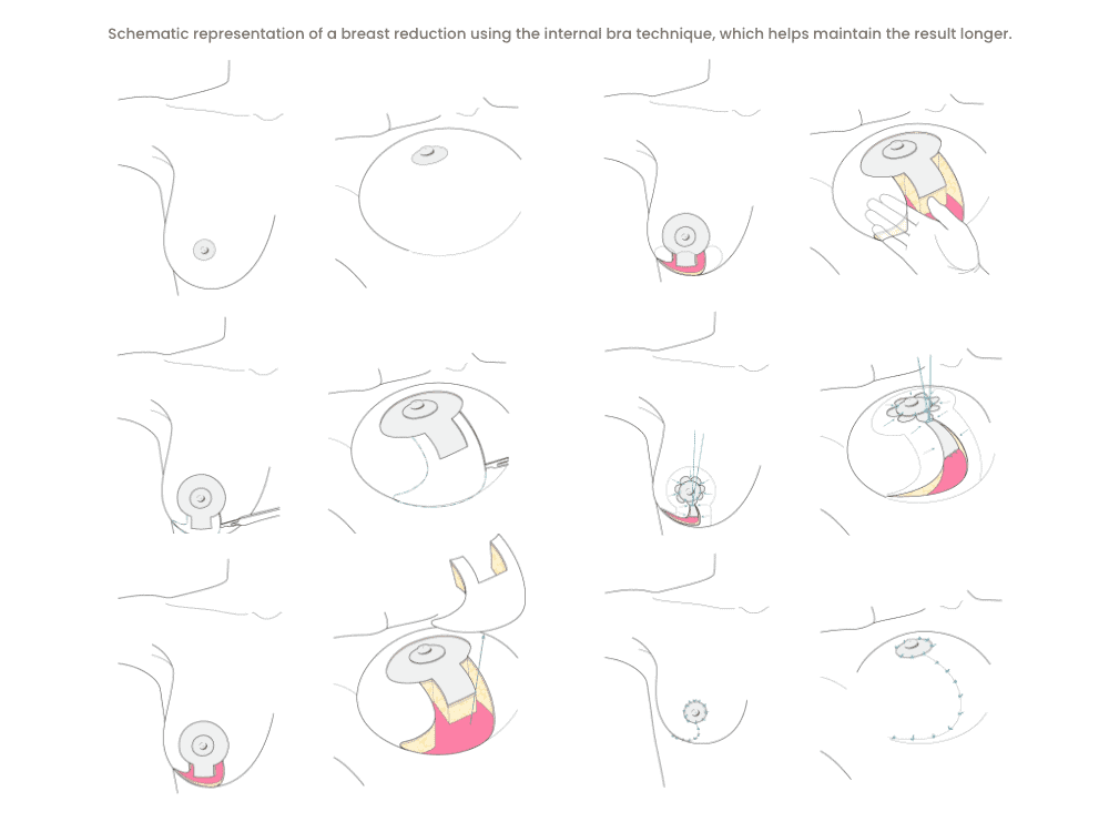 Schematische Darstellung der Brustverkleinerung mit interner BH-Technik.