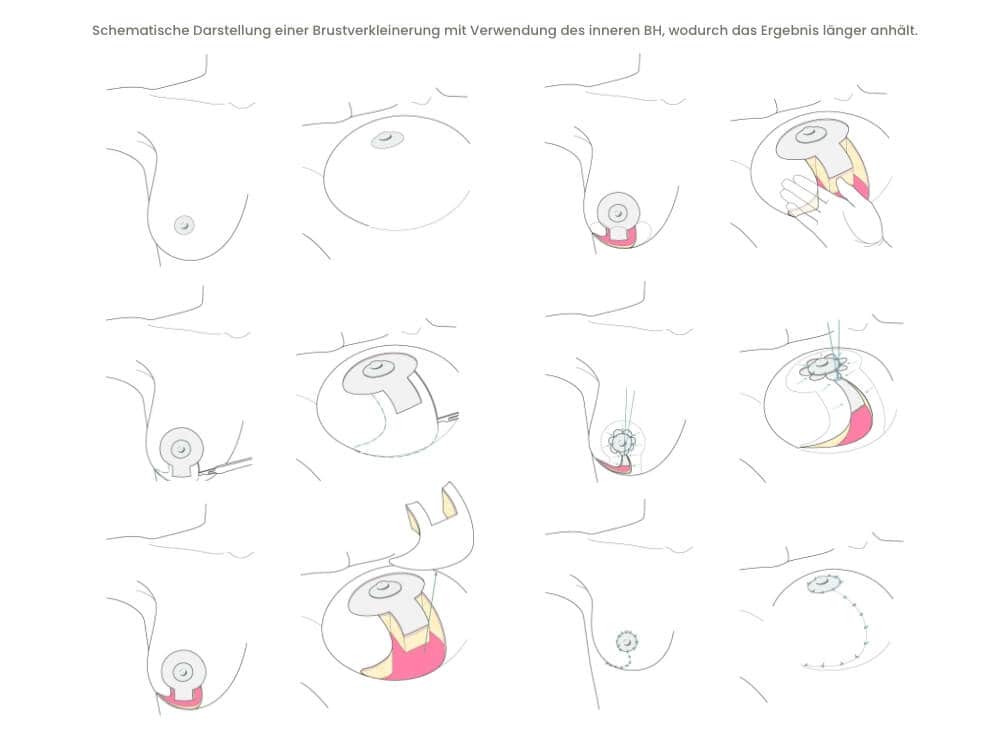 Illustration der Brustverkleinerung mit innerem BH für längere Haltbarkeit.