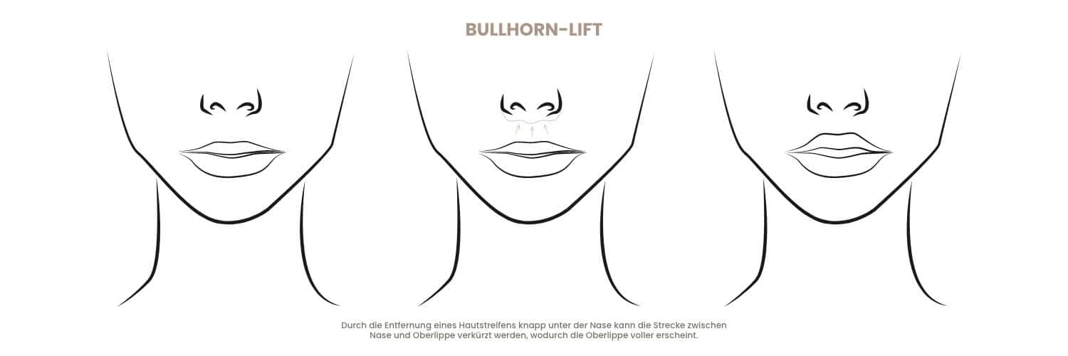 Illustration der Hals-Nasen-Ohren-Übung zur Stimmbildung.