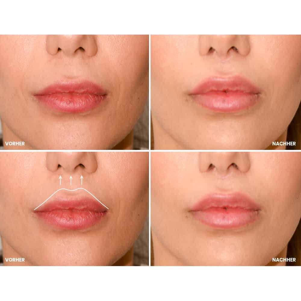 Lippenkorrektur vor und nach der Behandlung für ein jüngeres Aussehen.