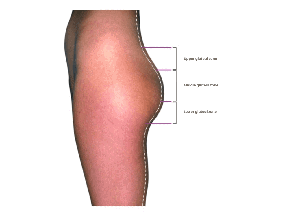 Anatomische Markierung der Hüft- und Oberschenkelmuskelzonen.