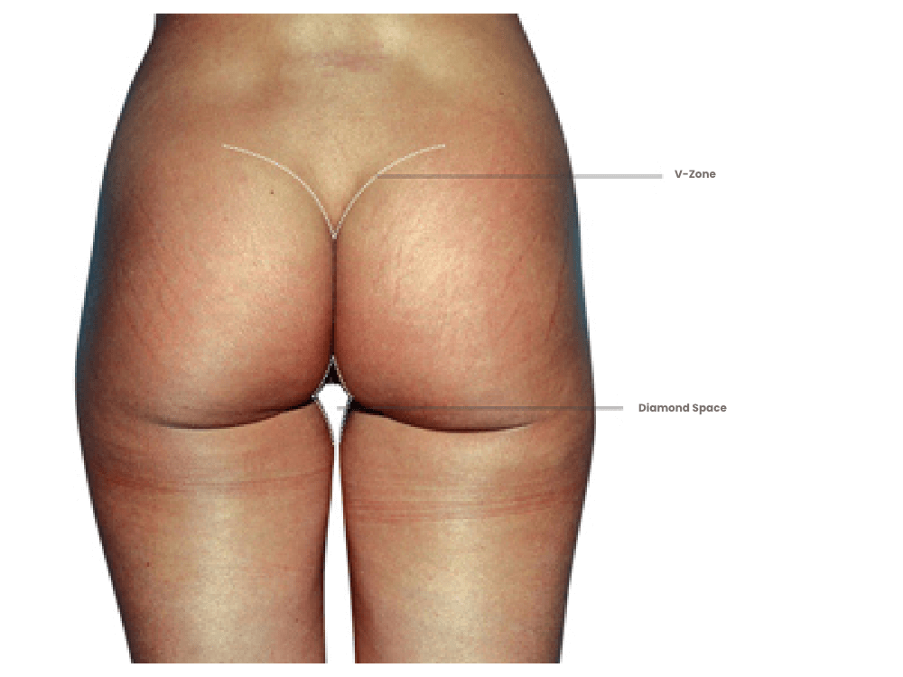 Markierte Bereiche am Gesäß und Oberschenkel für Fettabsaugung.
