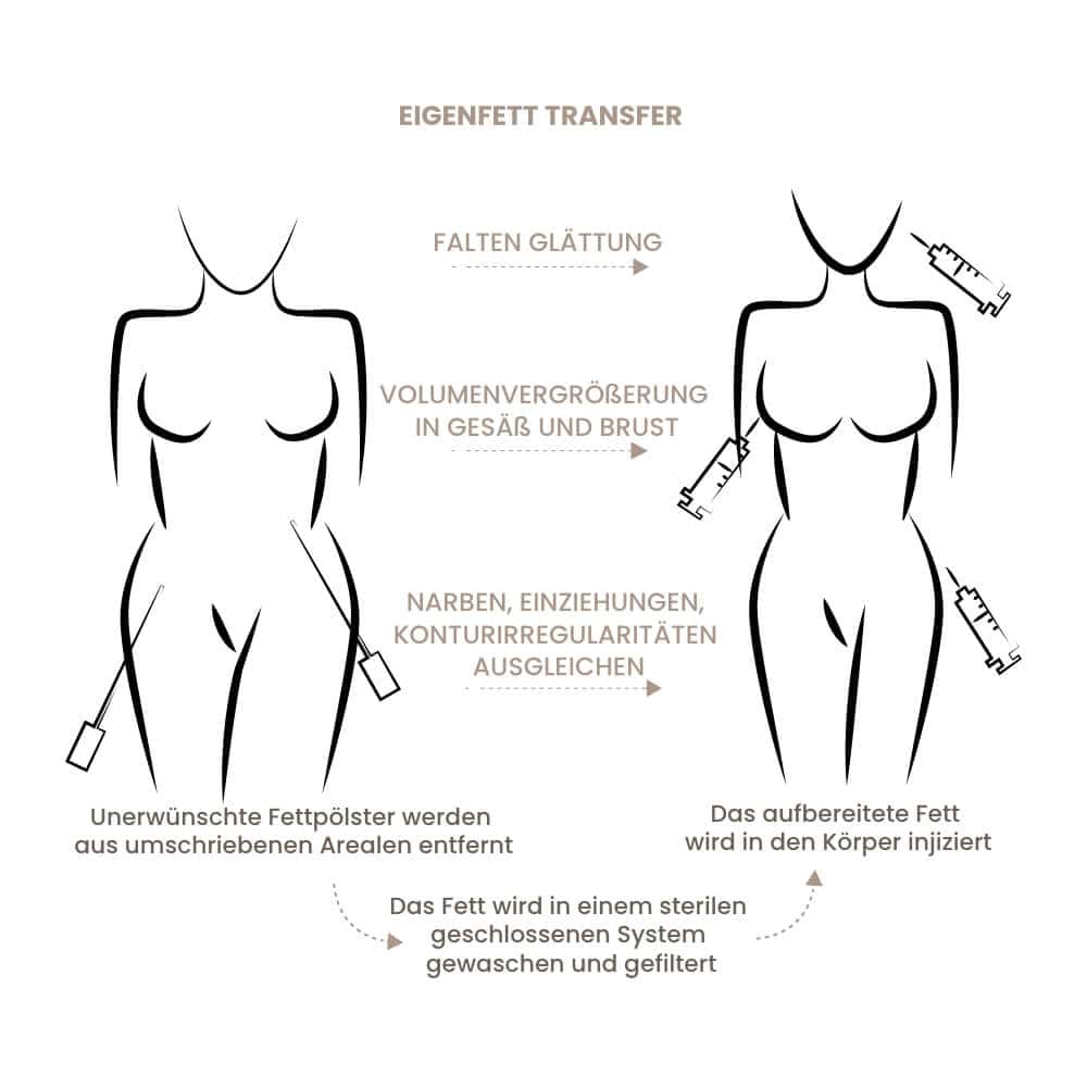 Illustration des Eigenfetttransfers zur Körperformung und Fettinjektion.