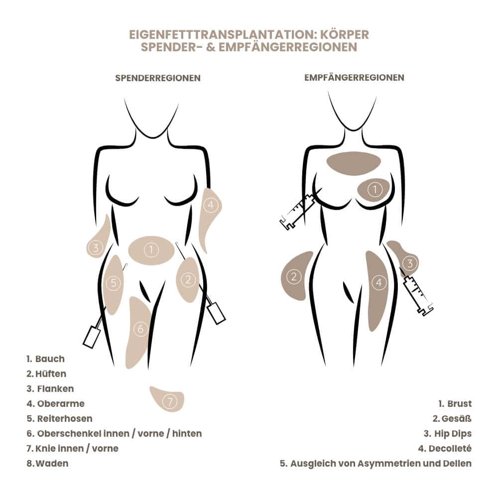 Illustration der Körperregionen für Eigenfetttransplantation bei Spender- und Empfängerbereichen.