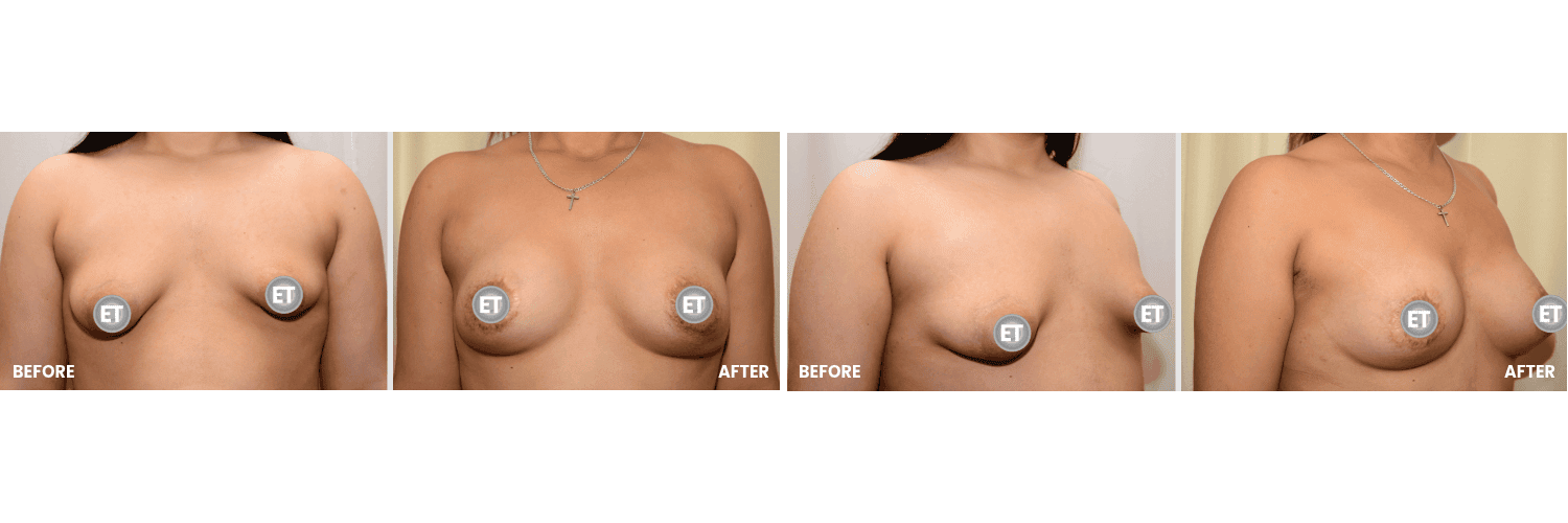 Vorher-Nachher Vergleich einer Brustvergrößerung, plastische Chirurgie.
