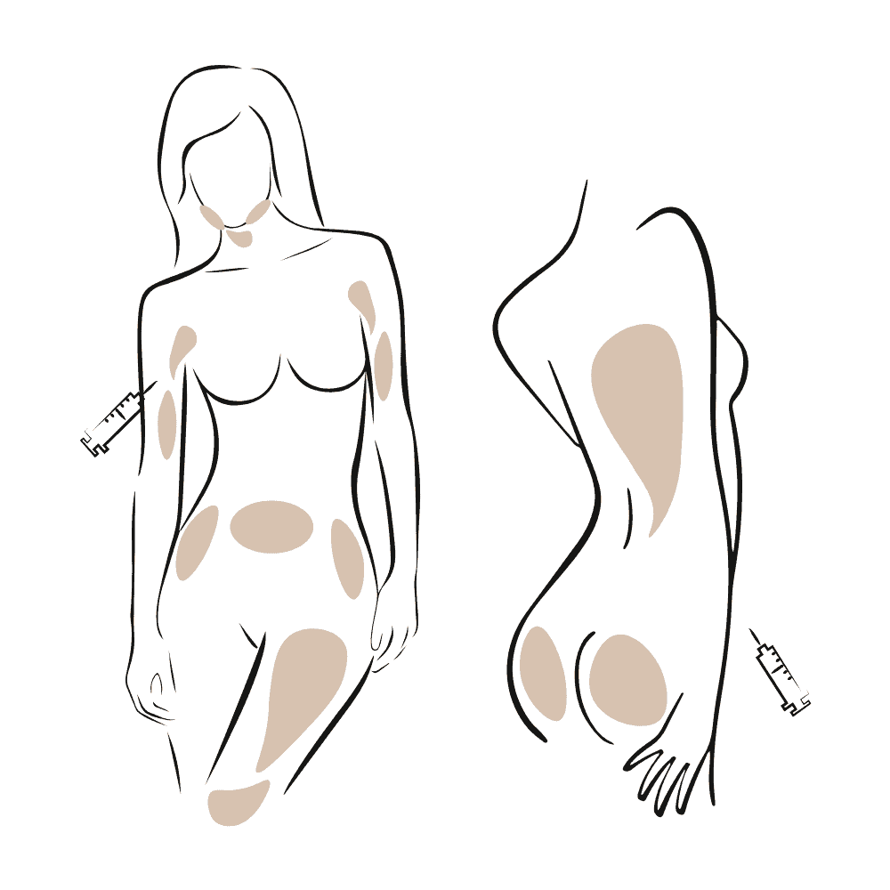 Illustration von Hautmarkierungen bei Injektionen am Körper und Arm.