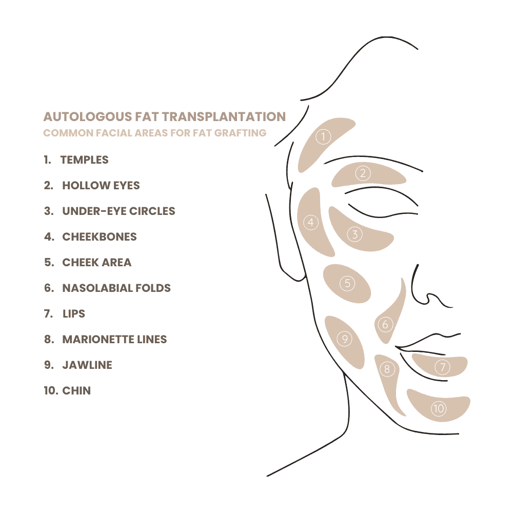 Diagramm der Gesichtsbereiche für Fetttransplantation und Faltenbehandlung.