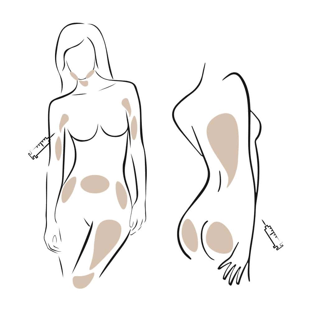 Illustration von Hautmarkierungen an verschiedenen Körperstellen für Injektionen.