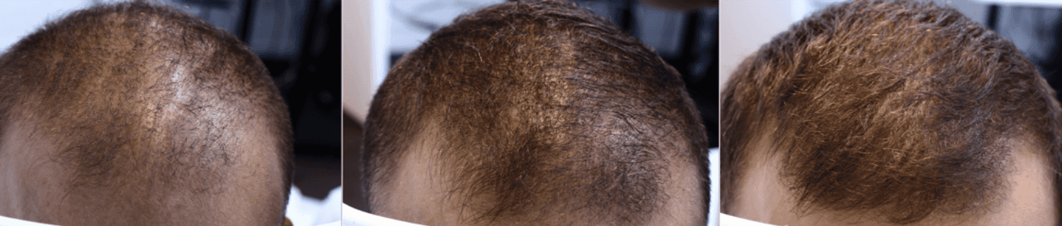 Vorher-Nachher Haartransplantation bei Turkof, Haarwuchs verbessert.