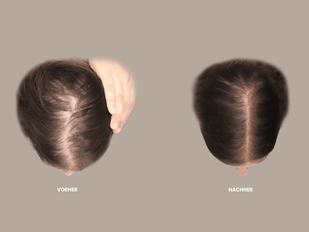 Förderung des Haarwachstums ohne OP