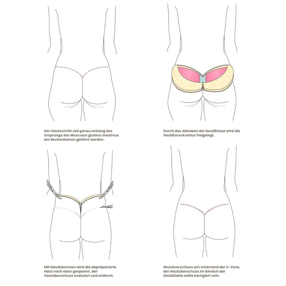 Illustration der Hautstraffung nach Fettabsaugung am Gesäß, mit Fokus auf Muskel- und Hautkontur.
