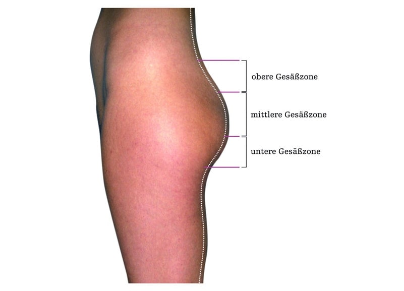 Diagram showing upper, middle, and lower thigh muscle zones.
