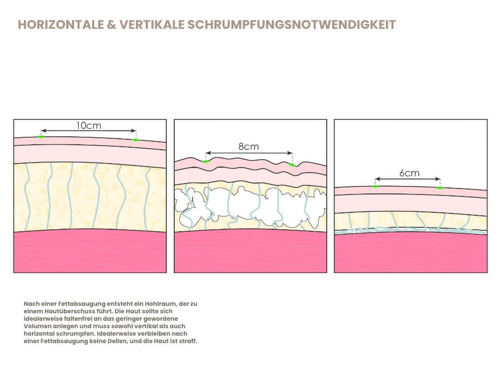 Hautschichten bei Hautalterung mit Diagramm und Maßen.