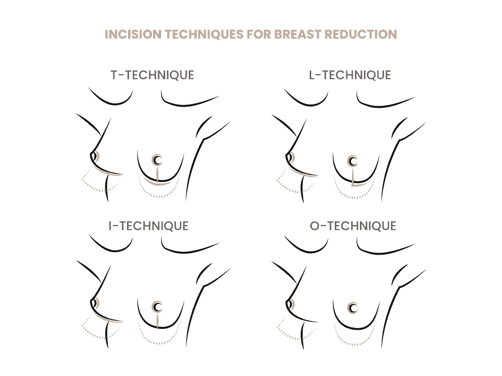 Diagramm zeigt verschiedene Inzisionstechniken bei Brustverkleinerung.