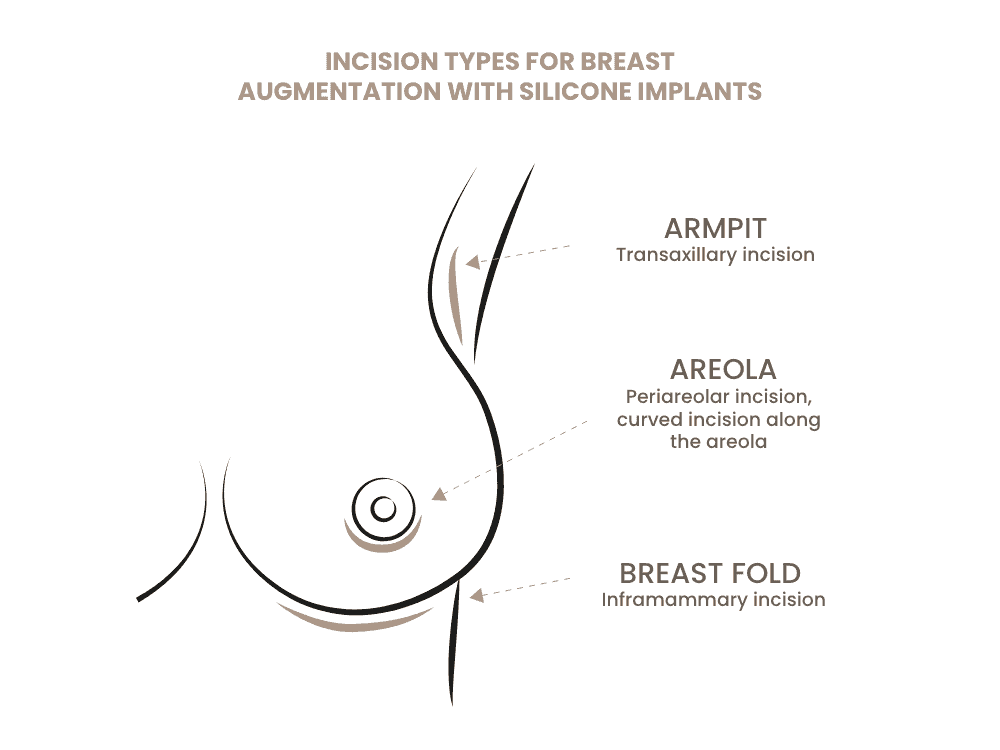 Illustration der verschiedenen Inzisionstypen bei Brustaugmentation mit Silikonimplantaten.