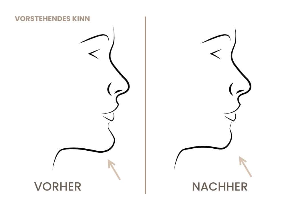 Vergleich von Kieferkorrektur vor und nach der Behandlung.