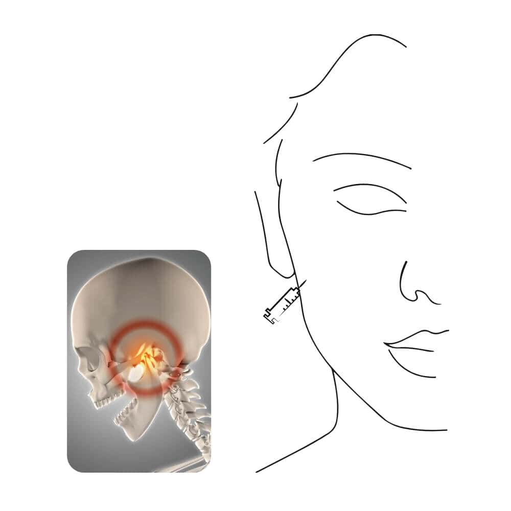 Illustration von Kopfschmerzen mit Nadel und Schädel, Schmerzpunkt im Kopf.
