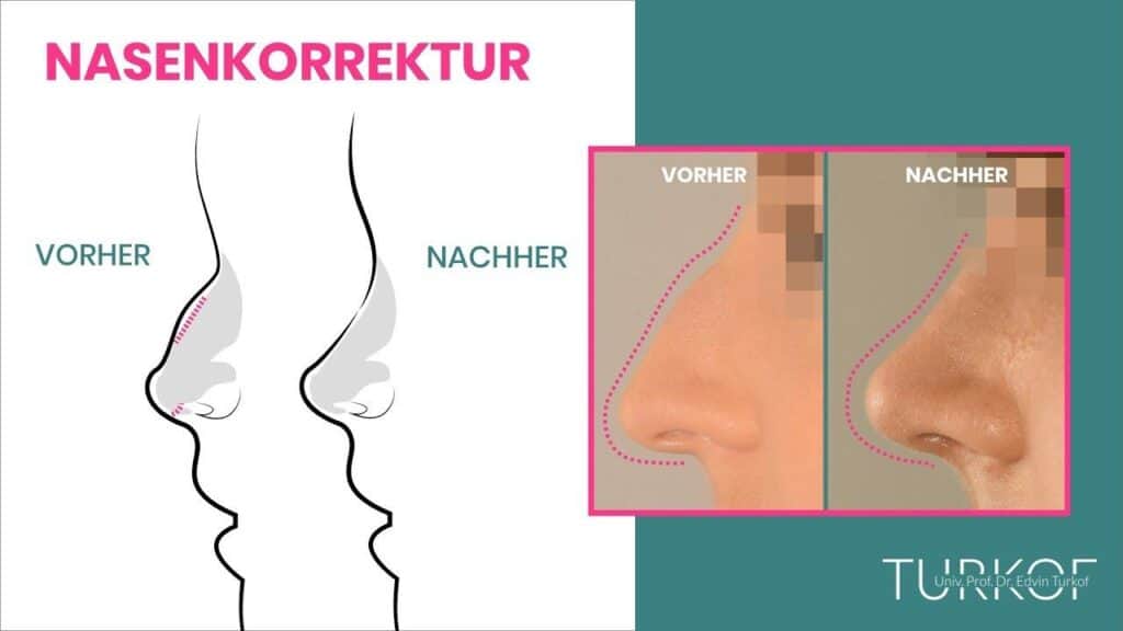 Nasenkorrektur
