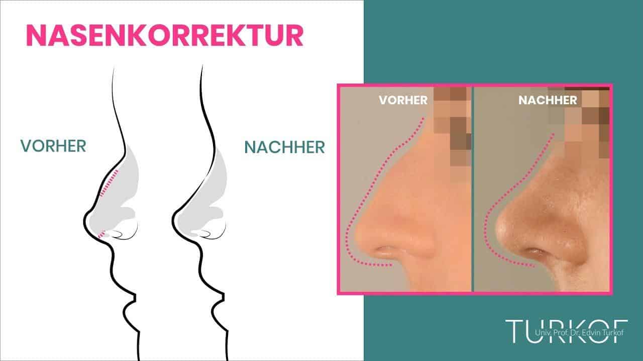 Nasenkorrektur