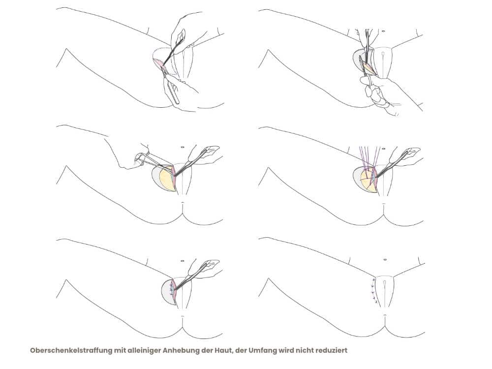 Hüftstraffung mit Hautanhebung: Minimalinvasive Methode zur Hautstraffung im Hüftbereich, ohne Reduk.