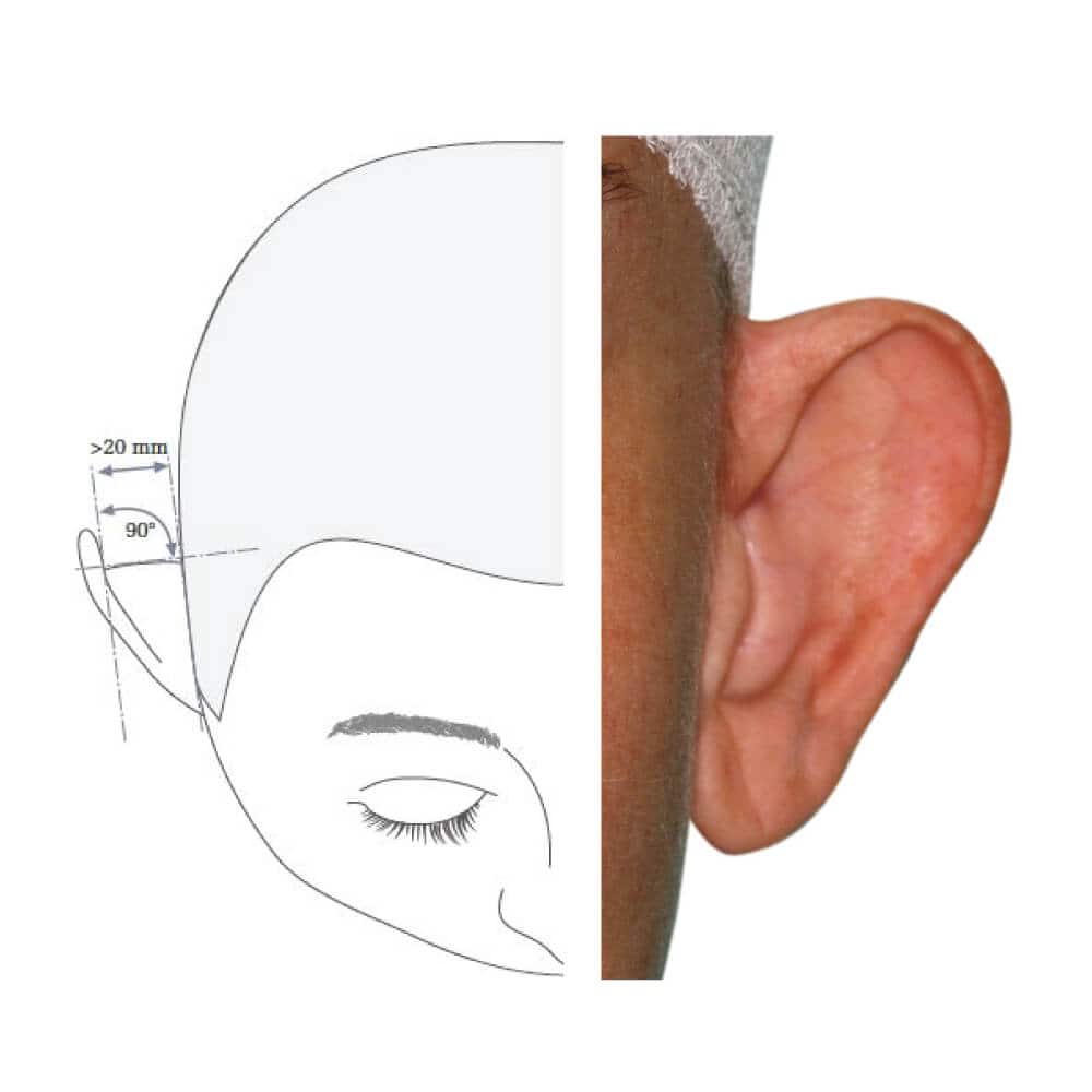 Hörgerät im Ohr mit anatomischer Ohrform für verbesserten Klang.