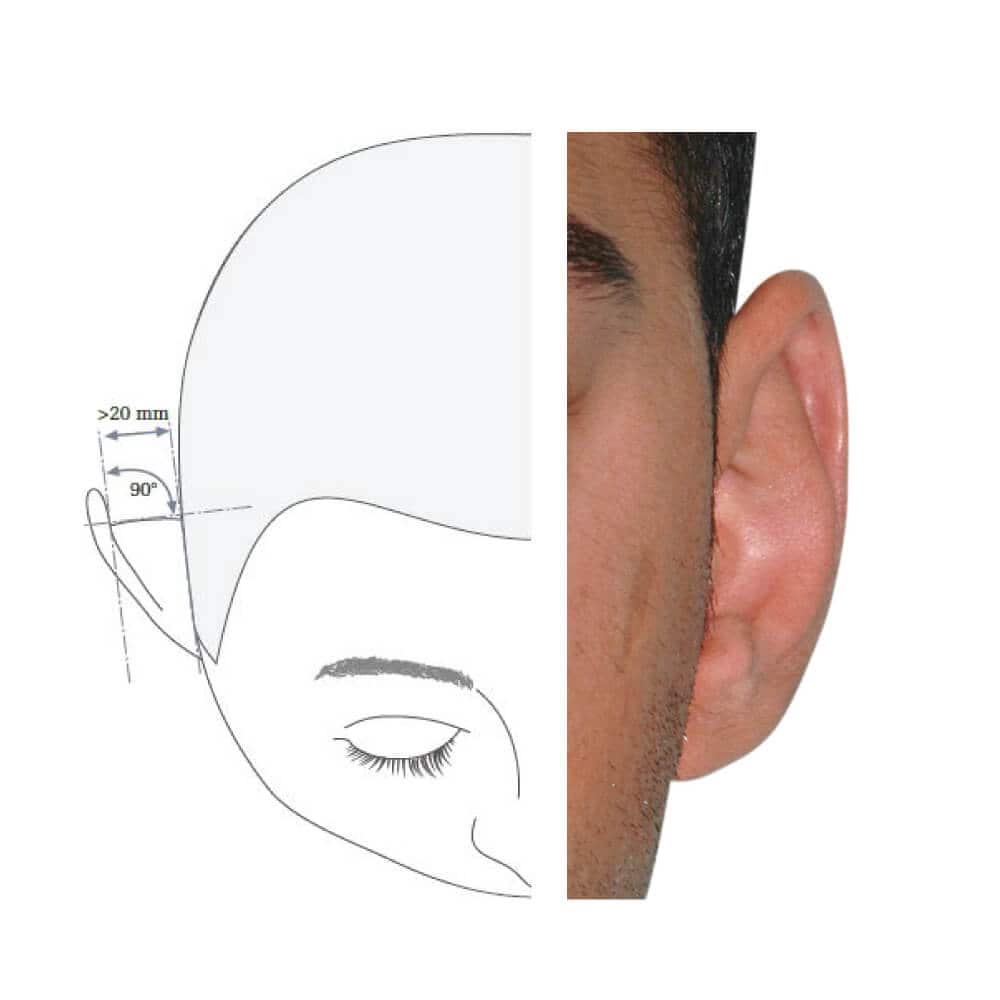 Illustration der Ohranatomie und Hörgeräte-Positionierung für optimale Akustik.