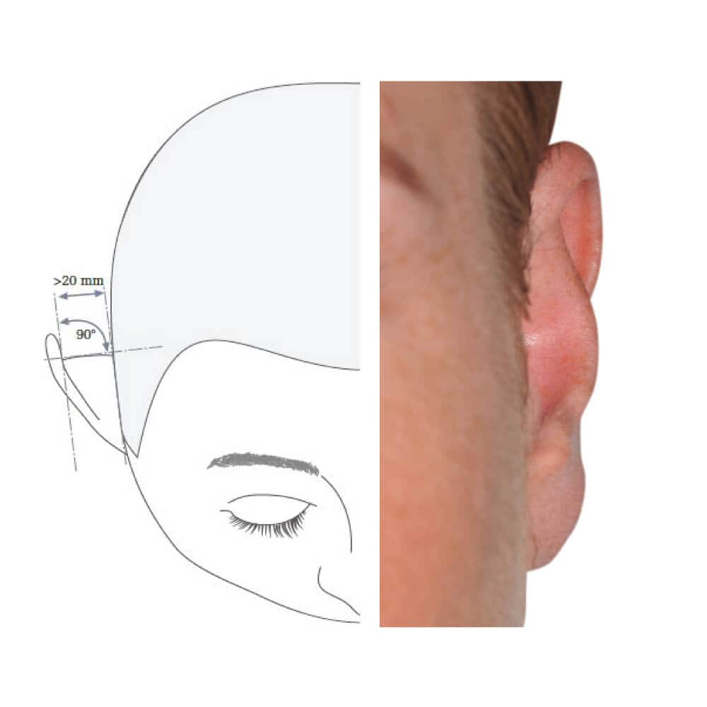 Illustration und Foto eines abstehenden Ohrs mit chirurgischer Korrektur.