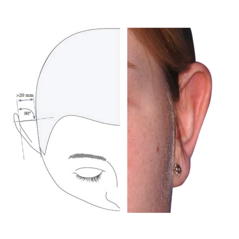 Schritt-für-Schritt-Diagramm und Ohraufnahme.