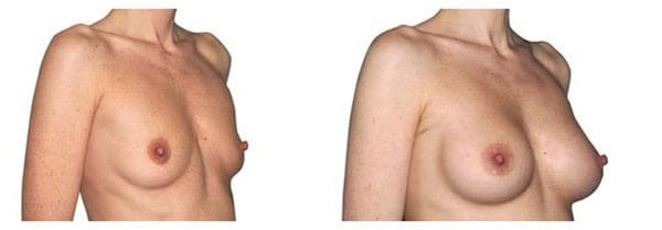 Vergleich von Brustvergrößerung vor und nach der Operation, plastische Chirurgie.