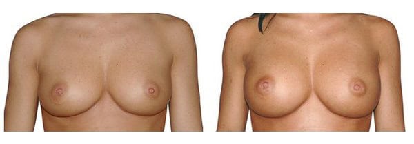 Vergleich von Brustvergrößerung vor und nach der Operation, plastische Chirurgie.