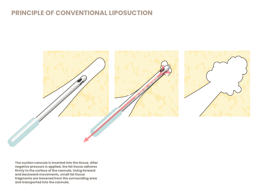 Illustration der Hautstraffung durch Liposuktion, medizinisches Verfahren.