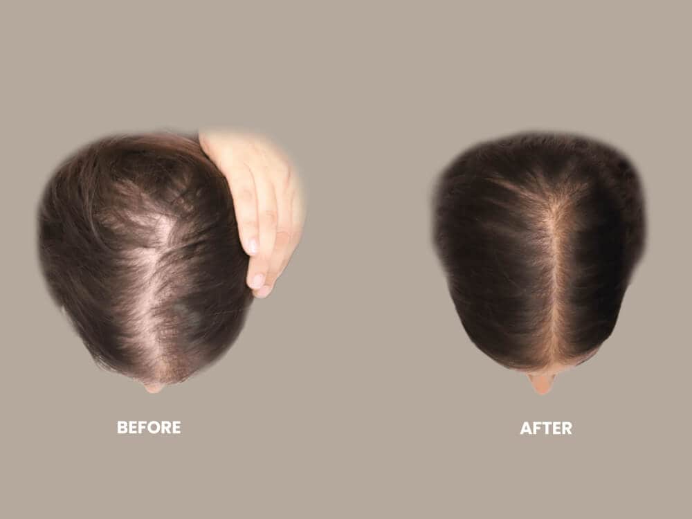 Non-Surgical Hair Growth Stimulation