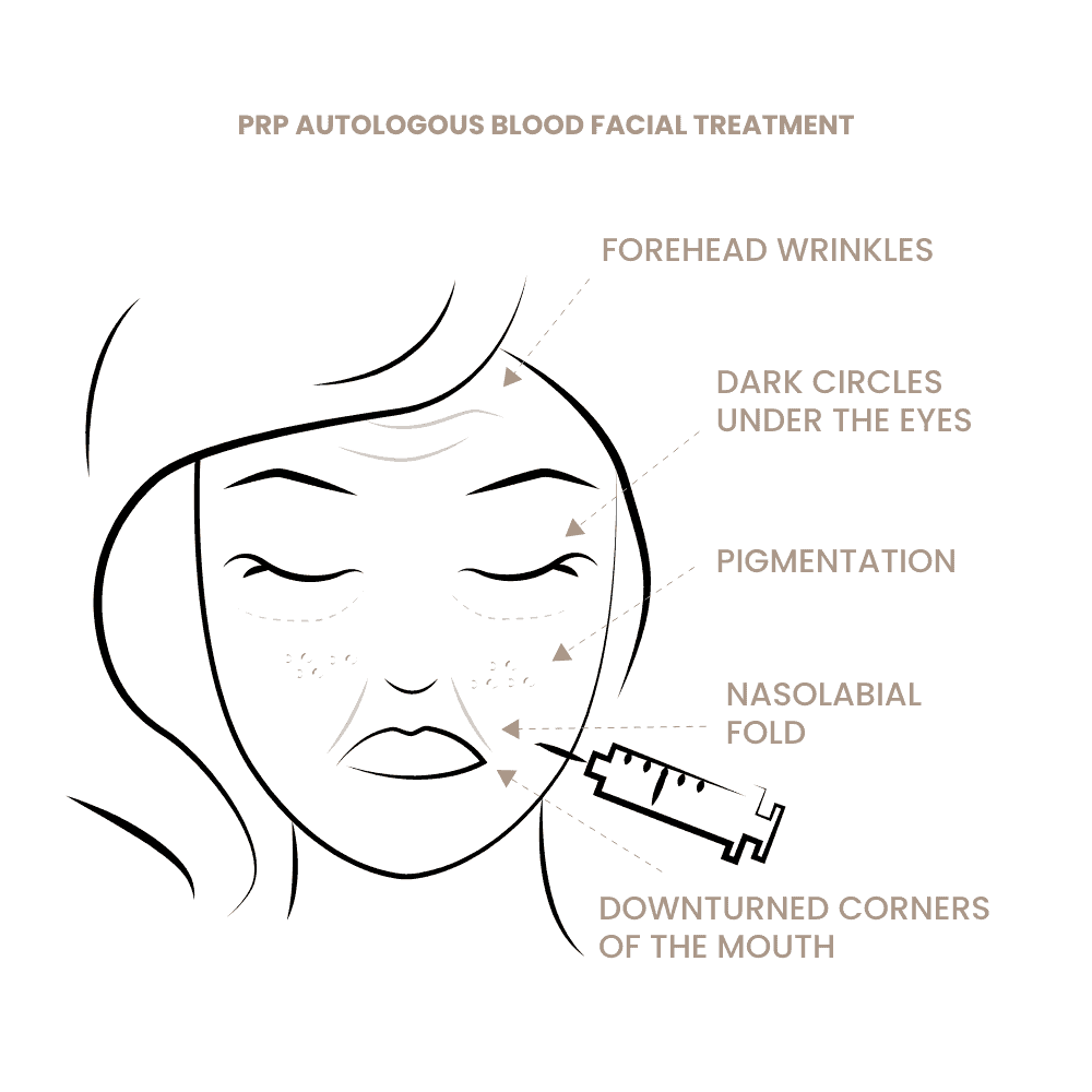 Illustration der PRP-Autologous Blood Facial Behandlung bei Falten und Hautalterung.