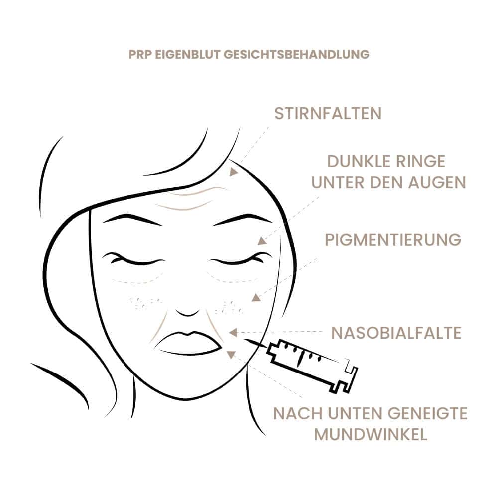 Illustration der PRP-Gesichtsbehandlung mit Fokus auf Hautverjüngung und Anti-Aging.