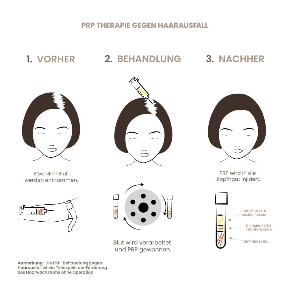 PRP-Therapie gegen Haarausfall, innovative Behandlungsmethode in Wien.