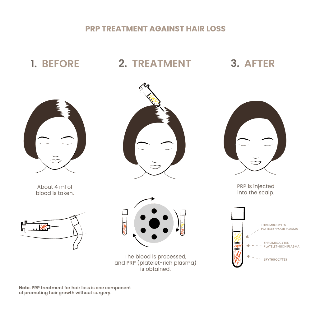 PRP-Therapie gegen Haarausfall, Vorher-Nachher Vergleich.