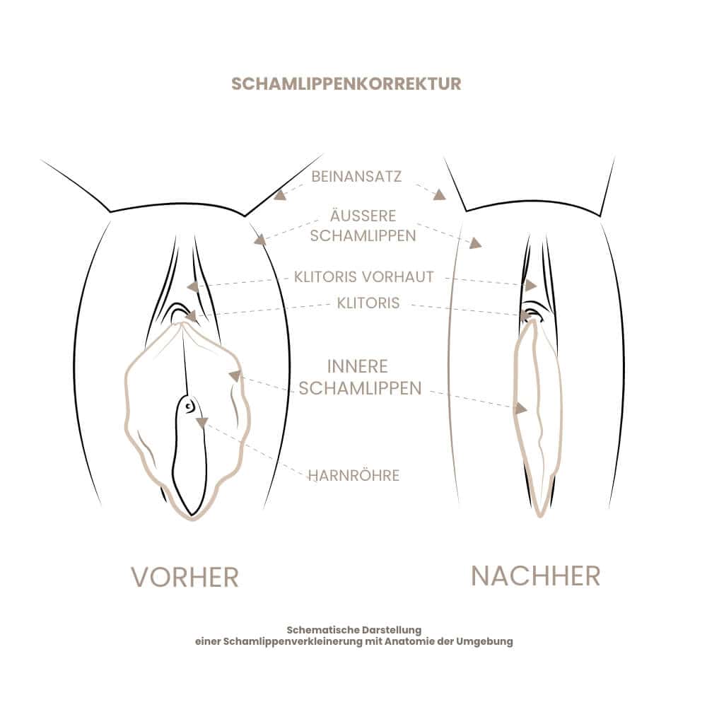Illustration der Schamlippenkorrektur mit Vorher-Nachher-Darstellung.