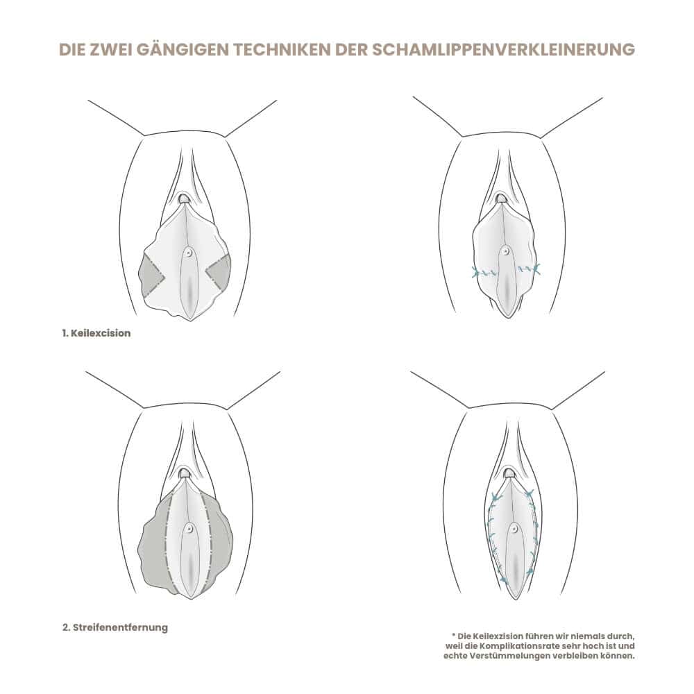 Illustration der Techniken zur Schamlippenverkleinerung, inklusive Keilexzision und Streifenentfernu.