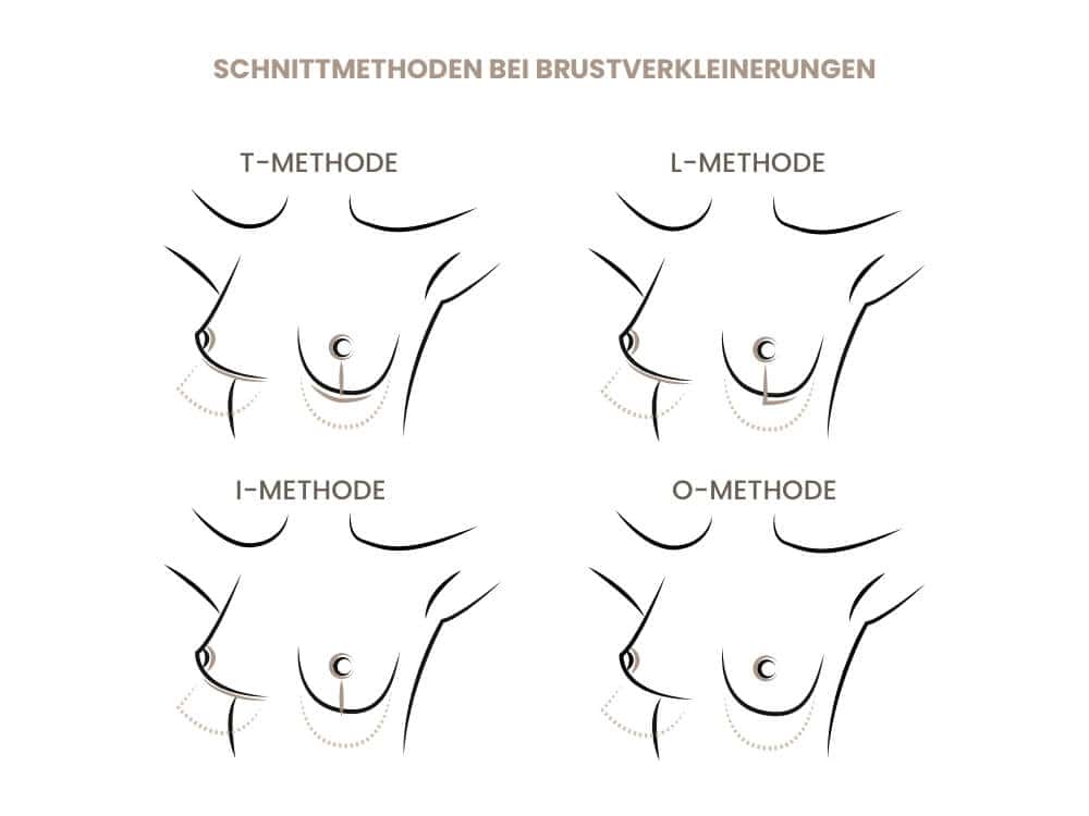 Illustration der Schnittmethoden bei Brustverkleinerungen, T-, L-, I- und O-Methode.