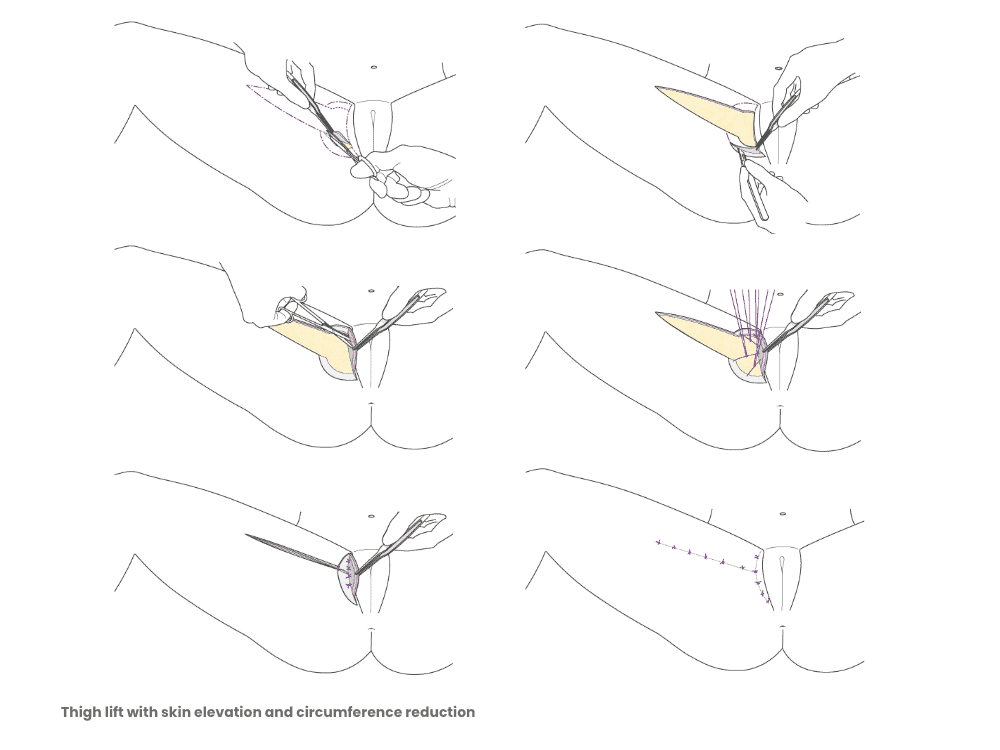 Illustration eines Hüftlifts mit Hautstraffung und Umfangreduzierung.