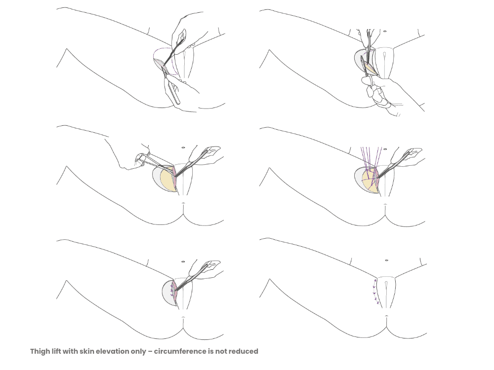 Medizinische Illustration eines Hüftliftings mit Hautstraffung, anatomische Details.