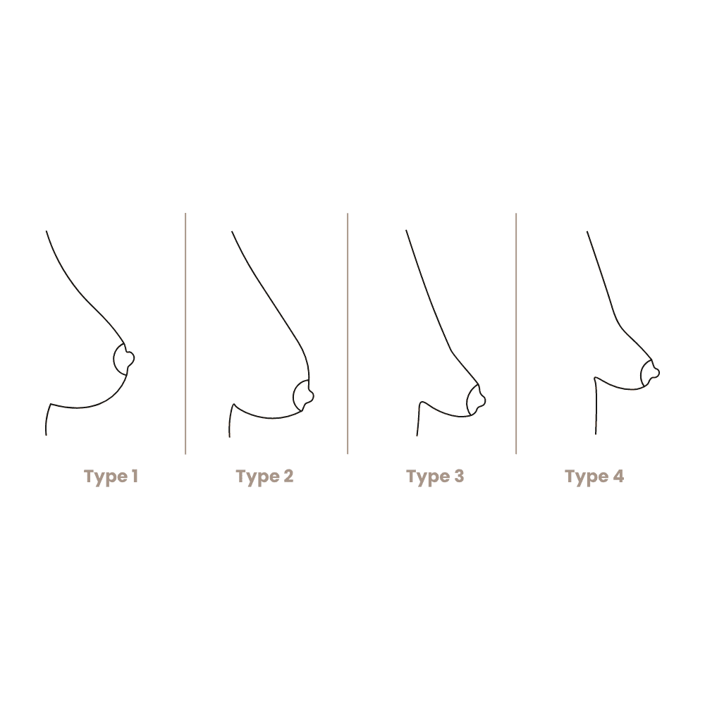 Diagramm zeigt verschiedene Brusttypen bei Frauen, von Typ 1 bis Typ 4.