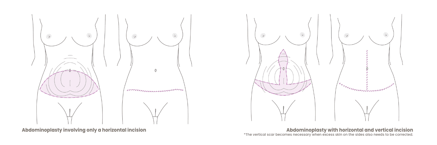Illustration der Abdominoplastie mit horizontalem Schnitt und Narbenverlauf.