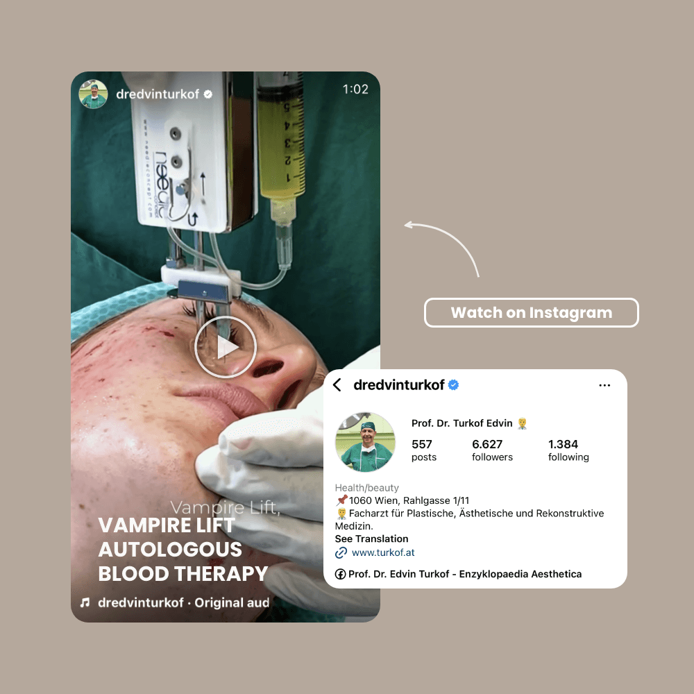 Medizinisches Vampirlift-Verfahren bei Patientin im Behandlungsraum.