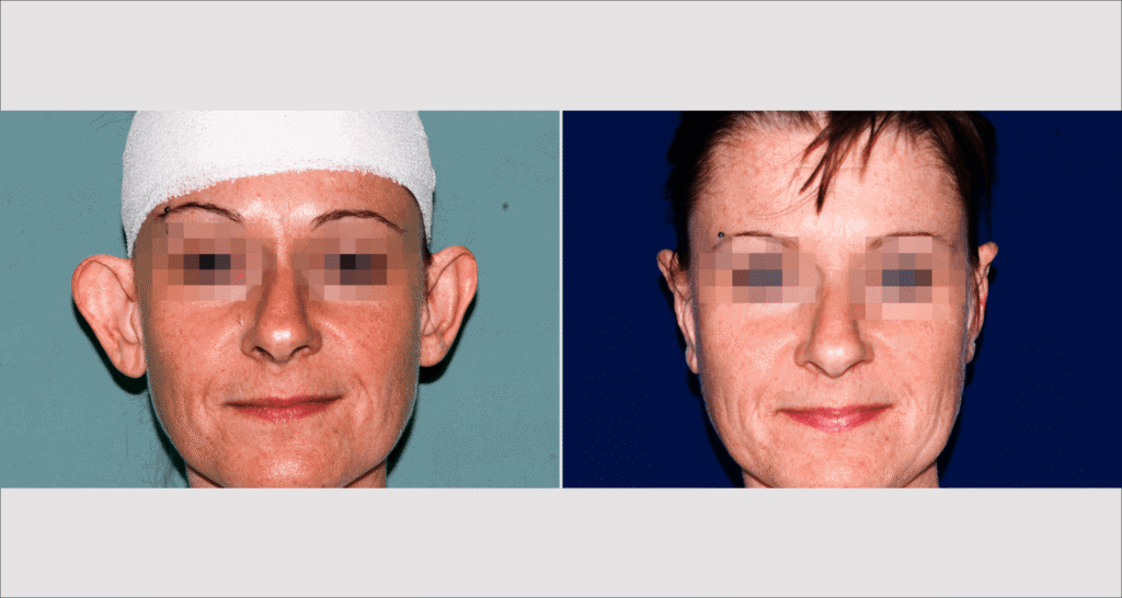 Vorher/Nachher Ergebnis: Abstehende Ohren