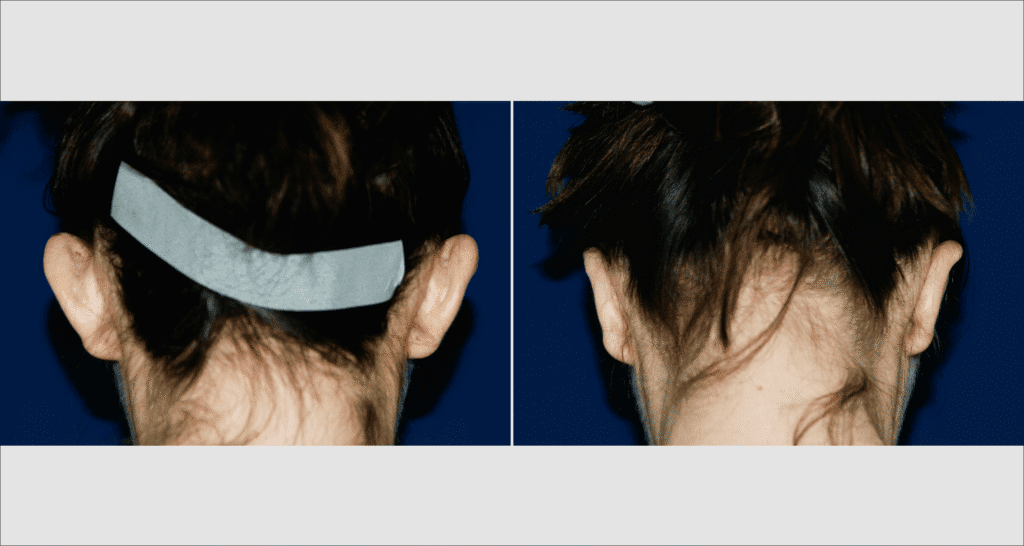 Vorher/Nachher Ergebnis: Abstehende Ohren