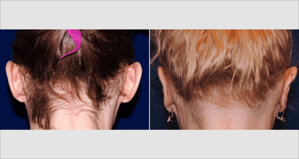 Vorher/Nachher Ergebnis: Abstehende Ohren